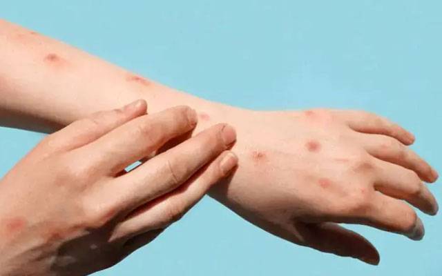 کراچی میں منکی پاکس کا ایک اور کیس رپورٹ، مجموعی تعداد 9 تک پہنچ گئی