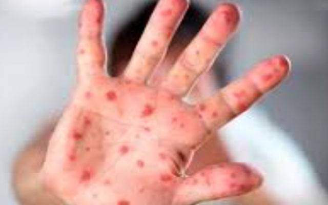 رواں سال ملک بھر میں خسرہ سے اموات کی تعداد 102 ہوگئی