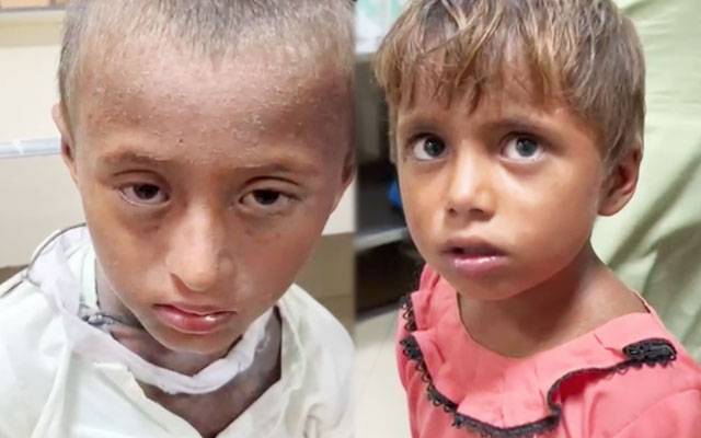 خانیوال میں ایک ہی خاندان کے 8 بچے خسرہ میں مبتلا، 3 جاں بحق