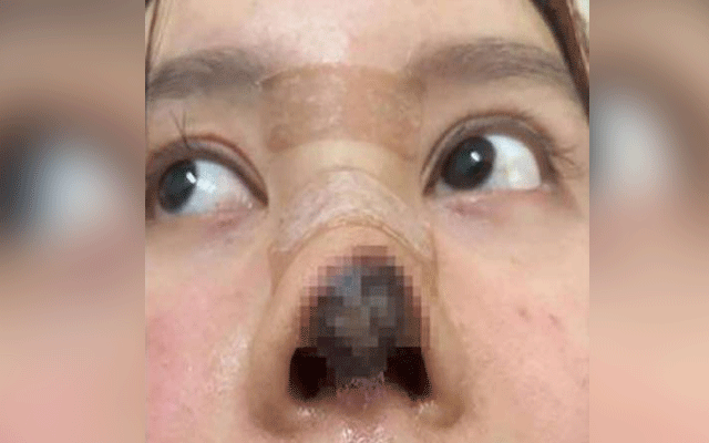 اداکارہ کی کاسمیٹک سرجری نے چہرہ بگاڑ دیا