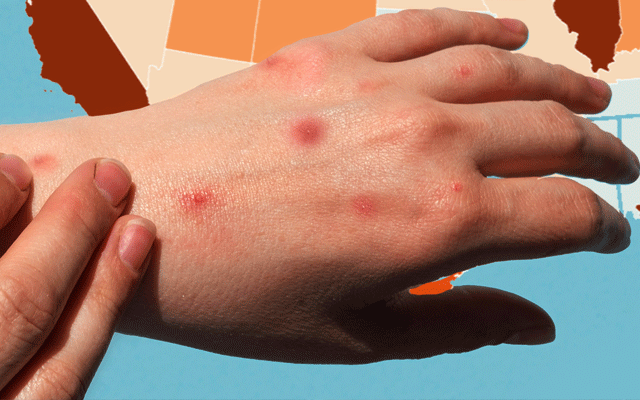 Monkeypox detected in a passenger arriving from Kahhak Saudi Arabia, Islamabad, PIMS, City42, National Institute of Health 