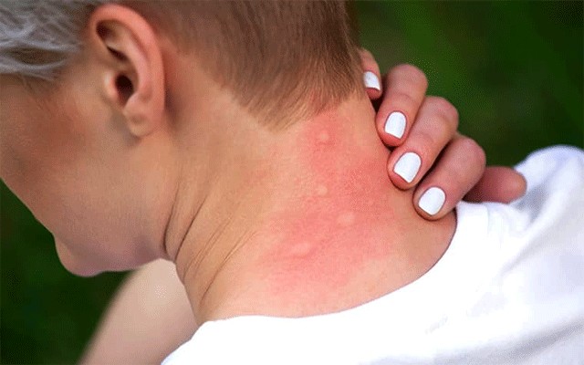 mosquito biting, carboxylic acids, butyric acid, monoterpenoid eucalyptol, City42 