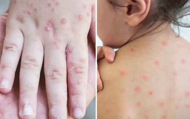  خسرہ کی صورتحال تشویشناک ہوگئی، گزشتہ 24 گھنٹے سے اب تک 321 نئے کیس رپورٹ ہوگئے۔ 