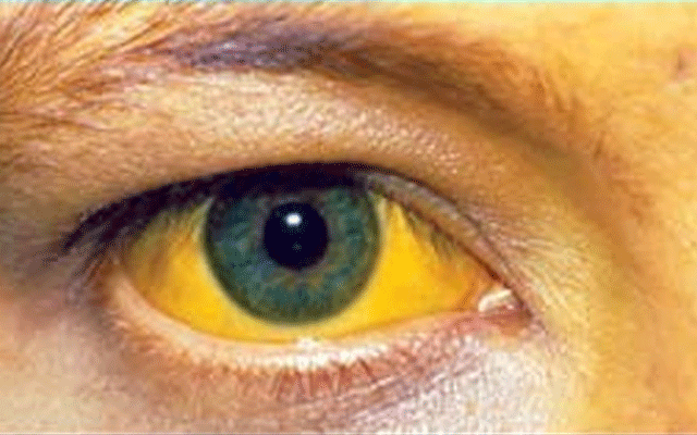Hepatitis B, Lahore , Hepatitis C, 