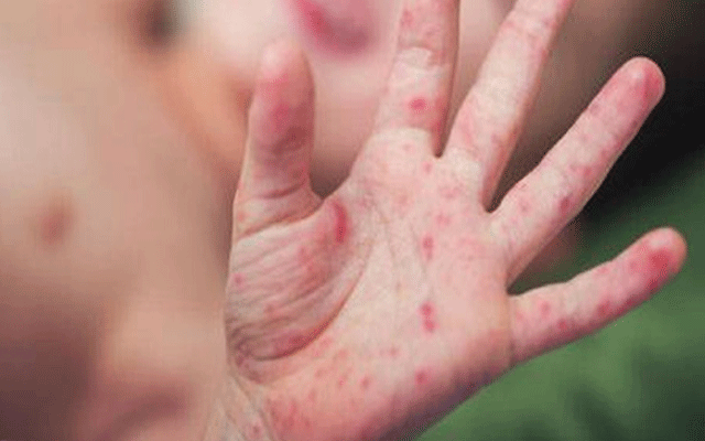 کشمور: خسرہ کے باعث معصوم بچی جاں بحق، علاقے میں وبا پھیلنے کا خطرہ